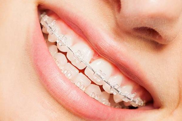 clear-braces-header